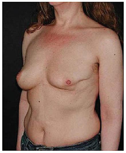 Patienten er blevet behandlet med konventionel brystbevarende kirurgi, men onkoplastisk brystkirurgi havde været relevant.