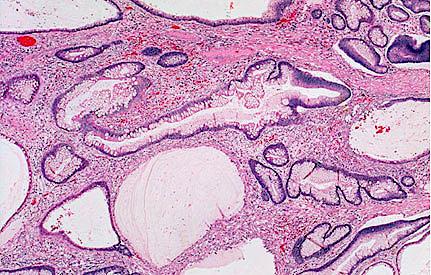 Mikroskopisk billede af juvenil polyp. Ved juvenile polypper ser man cystisk dilaterede kirtler, oftest mucusfyldte, med kubisk til cylindrisk epitel samt ødematøst og inflammeret stroma.