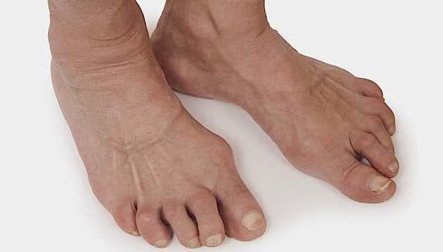 Methotrexat versus tofacitinib til behandling af rheumatoid arthritis.