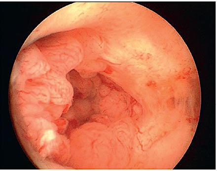 Endometrial cancer seen by hysteroscopy.