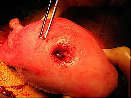 Peroperativt billede af uterusruptur.