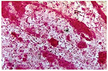 Mucus with partially autolysed leukocytes and Gram-negative rods = Pseudomonas aeruginosa- pneumonia (Gram stain × 1,000) (Photo: Niels Høiby).