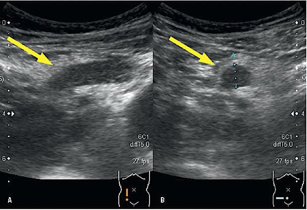 A. Longitudinalt snit over højre fossa med cøkalpol og appendix på langs. B. Horisontalt snit over højre fossa med tydeligt fortykket appendix på tværs med 9,9 mm anterior-posterior diameter