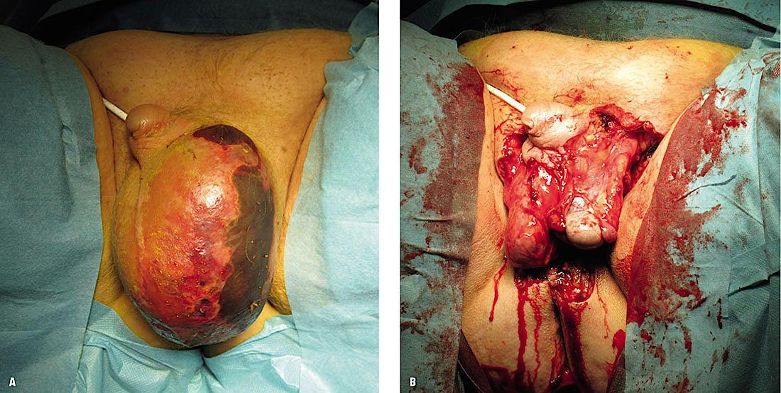 A. Hævelse og misfarvning af venstre skrotalhalvdel. B. Begge testiklerne ligger blottede efter resektion.