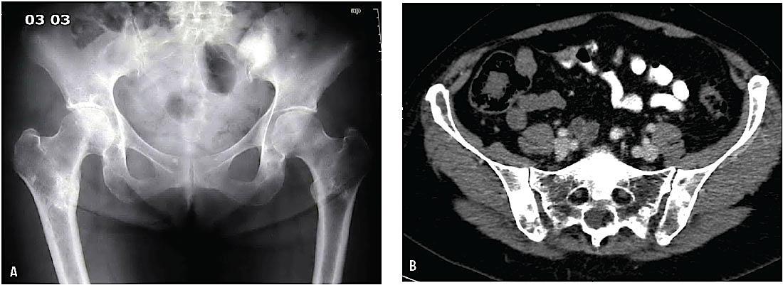 A. Multiple knoglemetastaser i pelvis og højre femur hos en patient med brystkræft. B. CT. Der ses komplicerende knoglemetastaser i os sacrum og pelvis hos en patient med brystkræft.