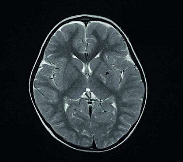 MR-skanning af cerebrum med infarkt efter varicella-zoster-virus-
infektion (pil).