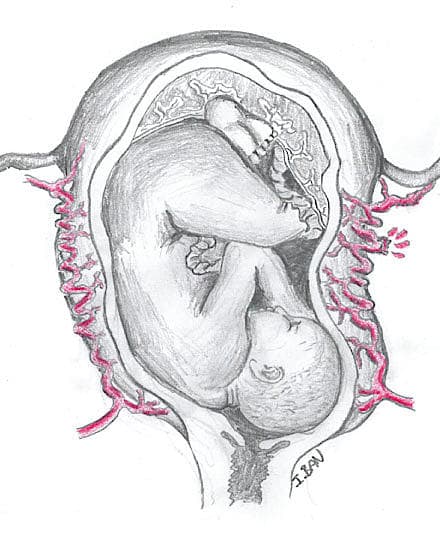 Spontan ruptur af a. uterina i gravid uterus.
