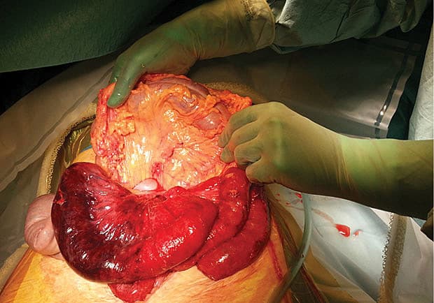 Second look-indgrebet. Der ses 15 cm gang­ræ­nøs tyndtarm og den suturerede defekt i mesocolon transversum.