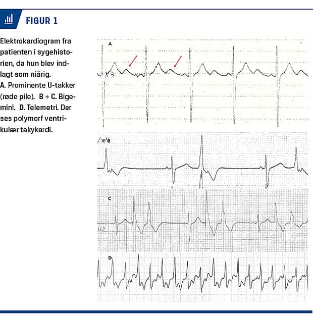 Molekylærgenetisk diagnostik af årsag til ventrikulær arytmi hos et ...