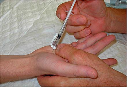 Injektion af kollagenase til behandling af Dupuytrens kontraktur.