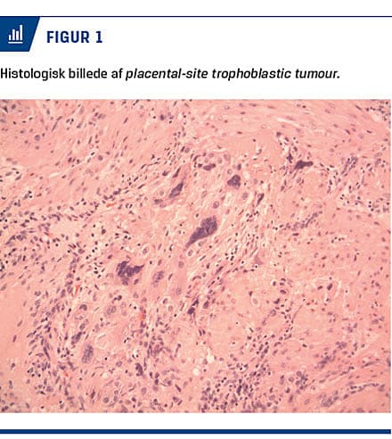 Pstt Placental-site trophoblastic tumour | Ugeskriftet.dk