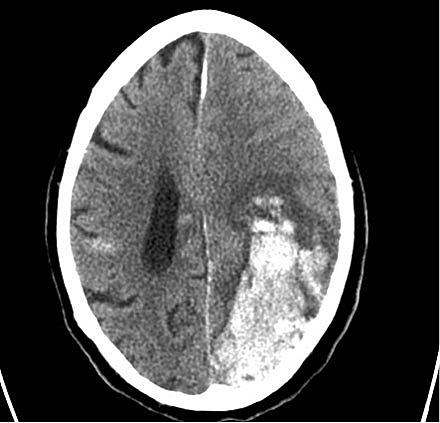 Intracerebral blødning på grund af interaktion med paracetamol og warfarin, der forårsagede stigning til international normaliseret ratio > 10.