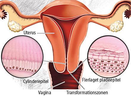 Koronalt snit af uterus og vagina. 