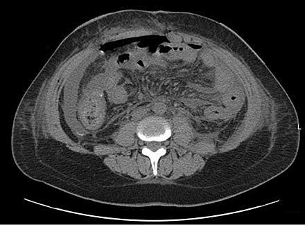 Intraperitoneal effusion med fri luft og ødem. Diffus peritonitis pga. anastomoslækage ved høj kolorektalanastomose [30]. Publiceres med tilladelse fra http://creativecommons.org/licenses/by/3.0/ 