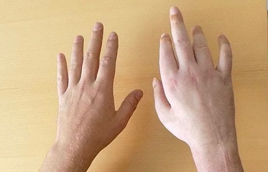 Komplekst regionalt smertedyndrom (CRPS)-klemningstraume af en hånd med nerve- og blødningslæsioner til følge og siden udvikling af CRPS.