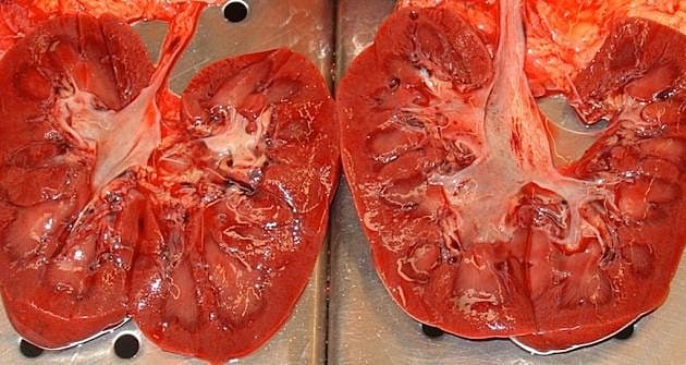 Nyrerne skåret igennem på tværs, post mortem, fra en patient, som døde af svær Esherichia coli-sepsis.