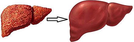 Fibrose og cirrose i leveren kan i mange tilfælde normaliseres ved ophør med hepatotoksisk påvirkning. Der forskes i lægemidler, der kan hjælpe processen på vej. 