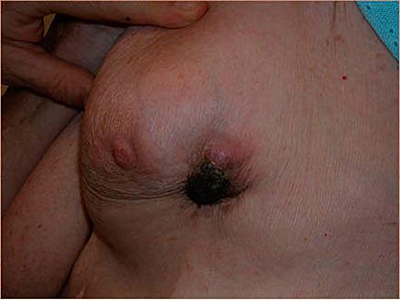 Isoleret lokoregionalt recidiv af brystkræft.