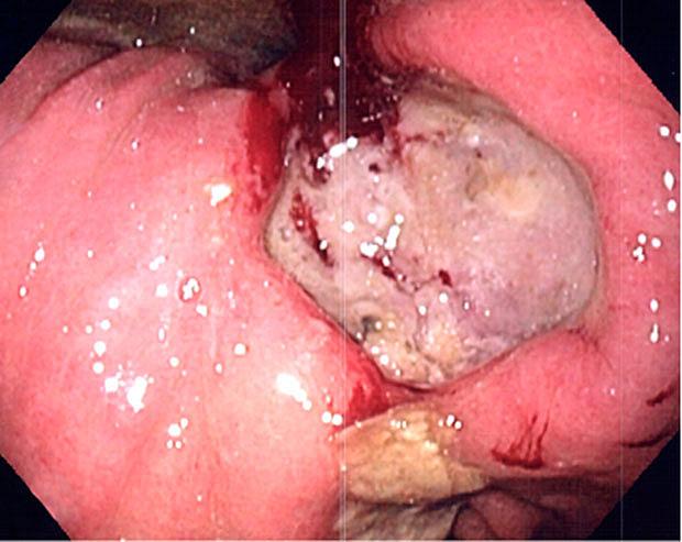 Fibrinbelagt ulcus ventriculi med randblødning.