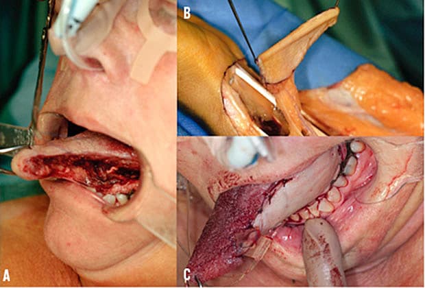 Resektion af tungen (A), rejsning af radial­islap (B)og endelig, lappen syet ind (C).