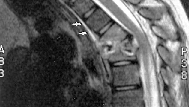 Intervertebral diskitis hos børn er sjælden og vanskelig at diagnosticere, fordi symptomerne er uspecifikke og kan forveksles med lidelser fra mange andre organsystemer.