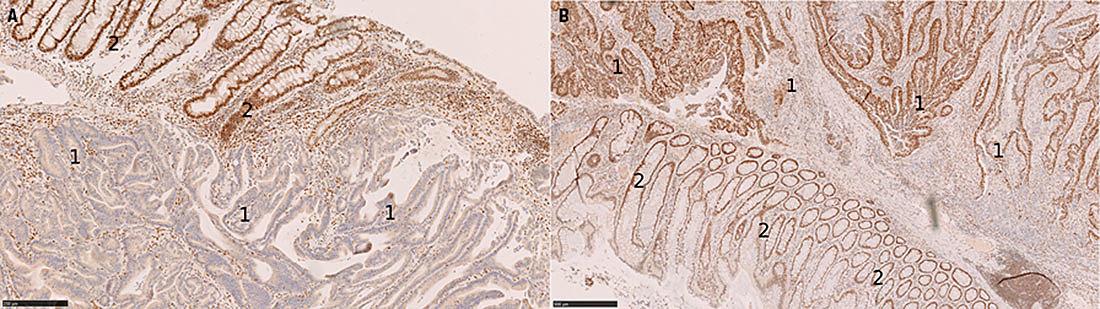 Snit af coloncancer med adenokarcinom (1) og normalt væv (2). Snittene er farvet med immunhistokemi mod mismatch-pro- teinet PMS2. Tumoren i A udtrykker ikke PMS2 i modsætning til tumoren i B.