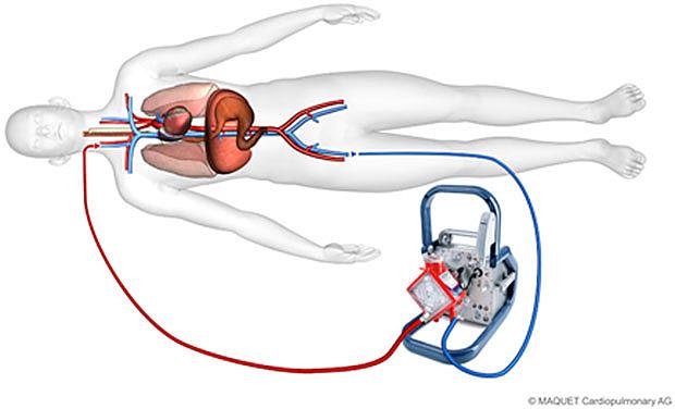 Ved veno-venøs ekstrakorporal membranoxygenering pumpes venøst blod ud via et kateter i vena femoralis, hvorefter det iltes, og CO2 udluftes. Illustrationen er bragt med tilladelse fra Maquet Nordic, www.maguet.com.