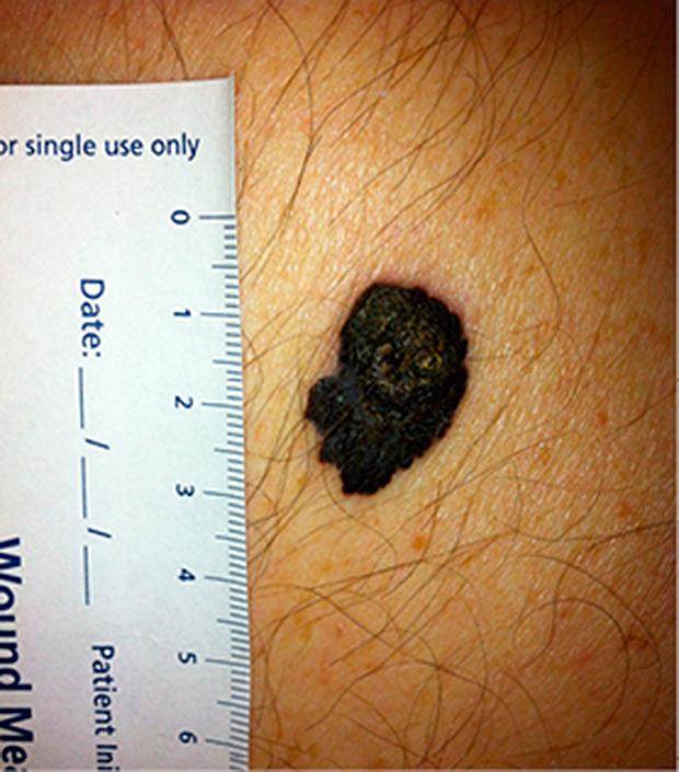Et superficielt spredende melanom. 