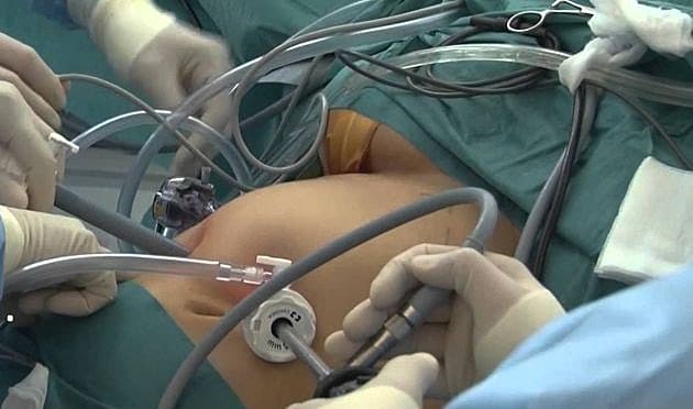 Gastrisk bypass-kirurgi giver godt vægttab hos teenagere, men langtidsfølgerne er ukendte.