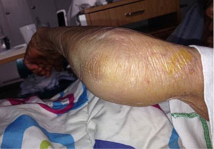 Monoartikulær septisk artritis i venstre albueled