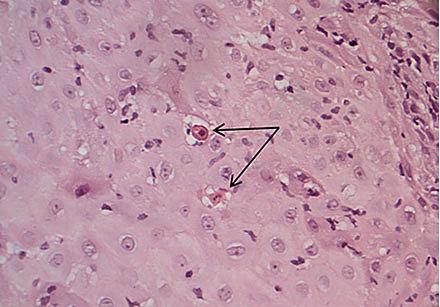 Histologisk dokumentation, hvor Civattelegemer er markeret med pile.