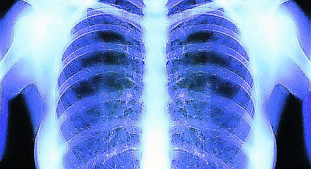 X-Ray Image Of Human Chest for a medical diagnosis
