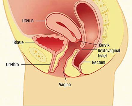 Rektovaginal fistel.