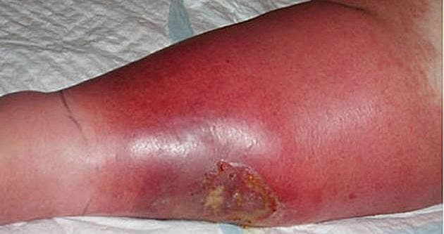 Patient med erysipelas med bulladannelse (afklippet) på låret. (Ill. fra statusartiklen)