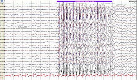 Klassisk spike-wave-paroksysme.