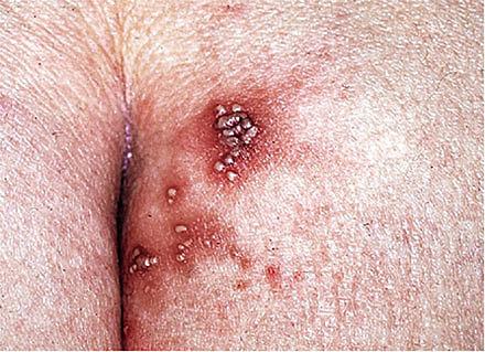 Herpes genitalis med vesikopustuløst udslæt på baller. (Billedet er gengivet med tilladelse fra Patienthåndbogen fra artiklen om Herpes genitalis).