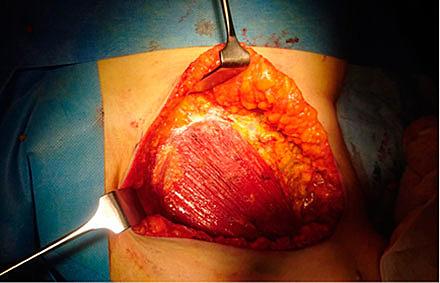 Mastektomioperation. Pectoralismuskulatur efter fjernelse af brystvævet.
