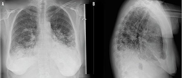 Bilateral Mycoplasma-pneumoni med vattede infiltrative forandringer. A. Frontalplan. B. Sagittalplan.