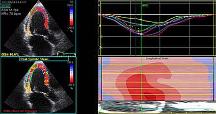 Ekkokardiografisk billede til udregning af myokardiets forkortningsfraktion, hvilket primært bruges i forskningssammenhæng inden for kardioonkologien. 