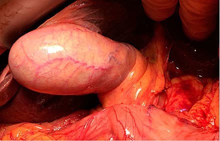 Galdeblære og dens omgivelser under åben operation.