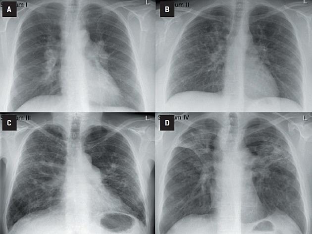 Radiologiske stadier ved sarkoidose. © Ugeskrift for Læger