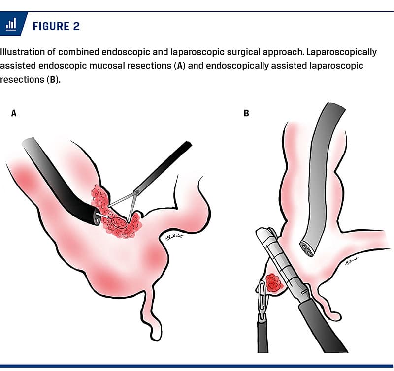 Cureus  Combined Laparoscopic Open Surgical Approach for De