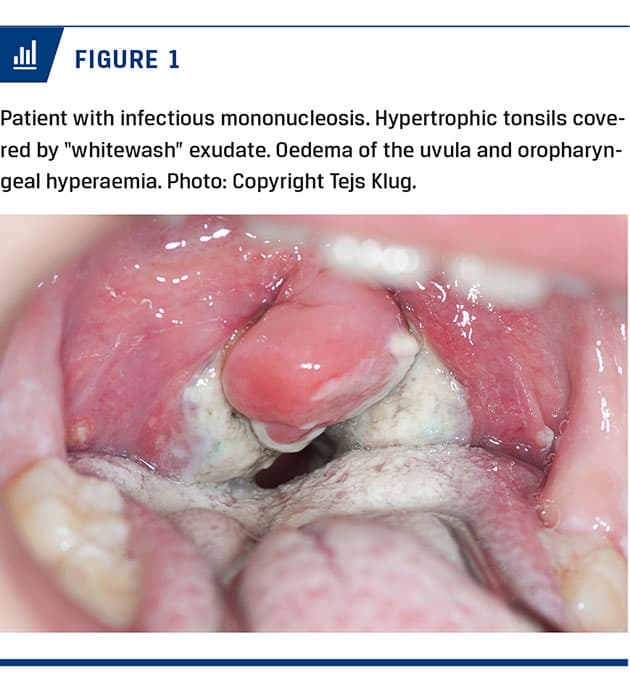 mononucleosis throat