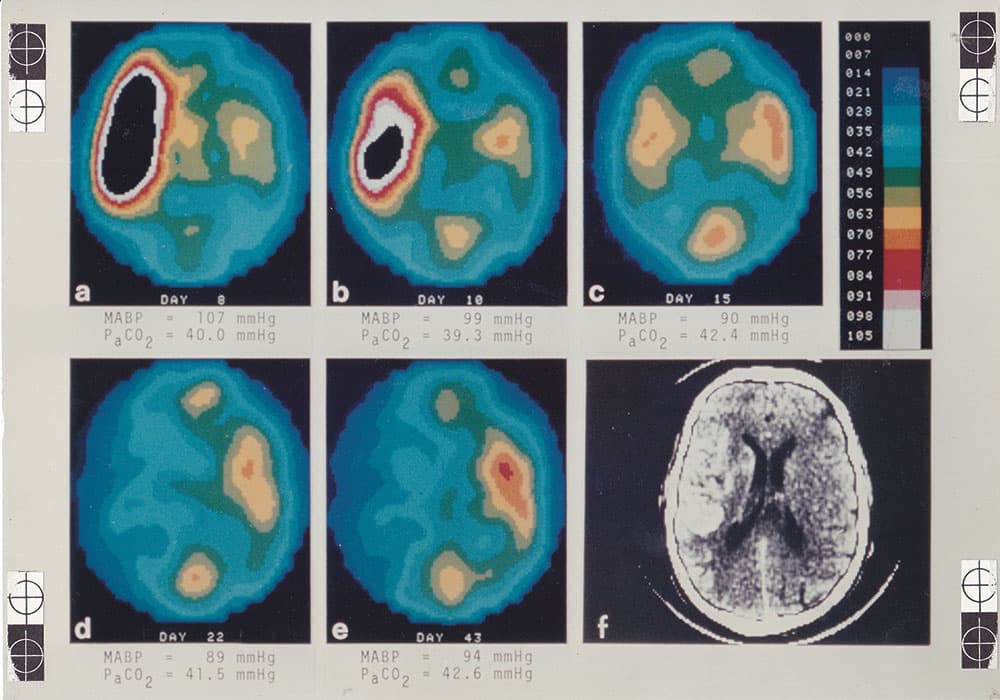 Tomografisk snit der viser det regionale blodflow i hjernen hos en patient med en stor læsion i højre hemisfære. I læsionen ses nedsat centralt blodflow med hyperæmi i randzonen. Dette svinder ved gentagne undersøgelser over de næste 47 dage. Undersøgelsen er udført i 1985 med tomografen Tomomatic-64 og inhalation af xenon-133 (Fra Niels A. Lassens lysbilledsamling).