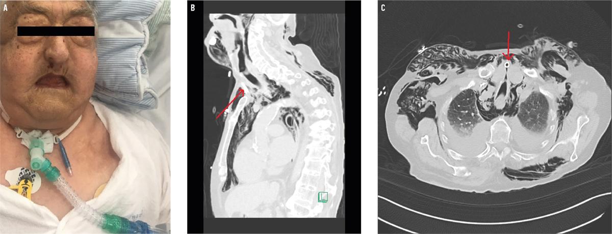 A. Subkutant emfysem ved øjenregionen. B + C. CT-snit af trakealkanyle (pile) siddende anteriort for trachea.Foto gengivet med tilladelse fra patienten.