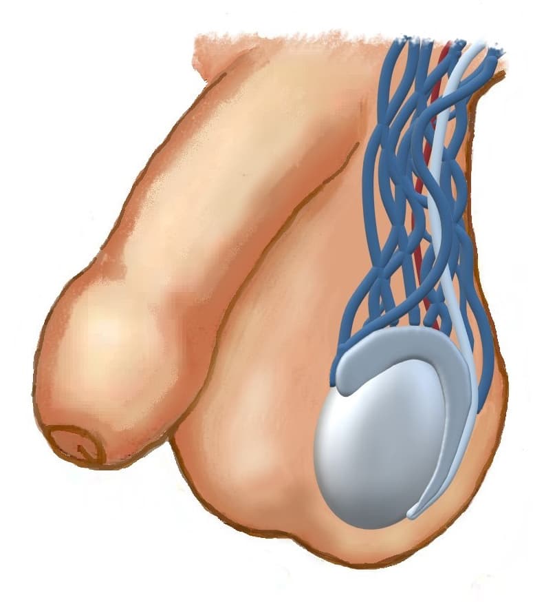 Venstresidigt varicocele. (Tegning: Ulla Nordström Joensen).