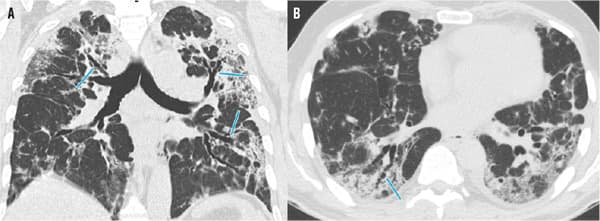 Blandingsbillede med både matglasinfiltrater og mere konsoliderede infiltrater samt moderate og udtalte traktionsbronkiektasier (pile). A. Koronalt snit. B. Aksialt snit.