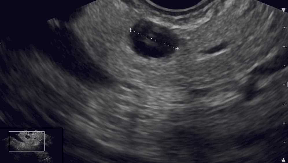 Endoscopic ultrasound showing a suspected 7-mm branch duct intraductal papillary mucinous neoplasm of the pancreas.