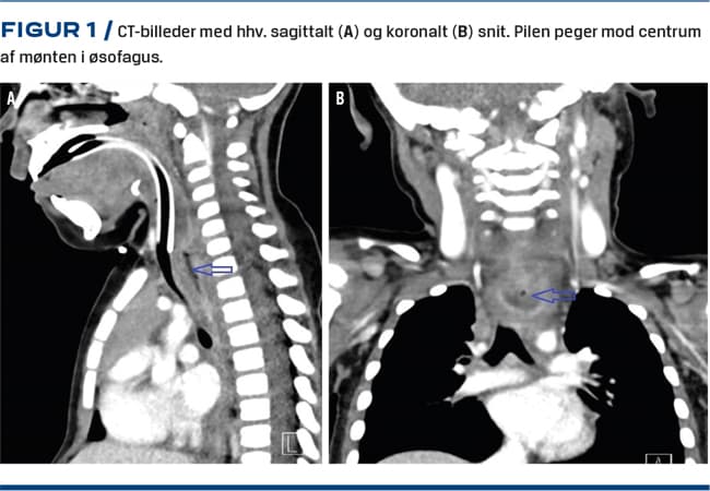 Plastmønt i øsofagus hos en etårig med langvarige symptomer på ...