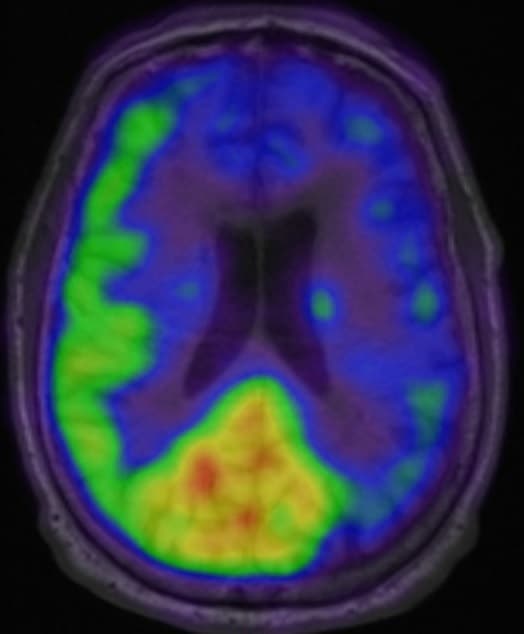 15O-H2O-PET/MR-skanning viser nedsat perfusion i venstre hemisfære efter indgift af acetazolamid.